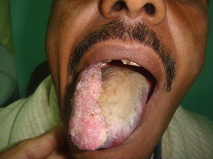 malignant-tumor-of-the-tongue-1_1853